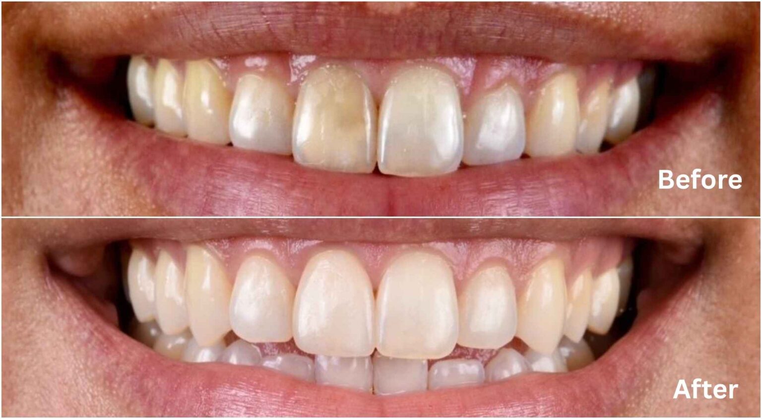 Before and after photos of Whitening Treatment | Astute Clinic KL
