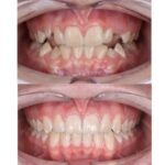 braces 1