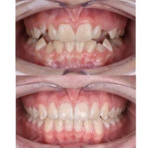 braces 1