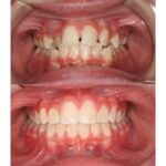 braces 2