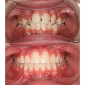 braces 2