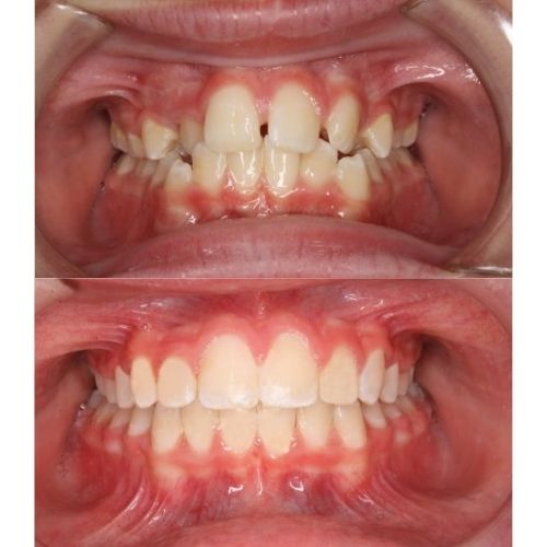 braces 2