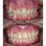 braces 3