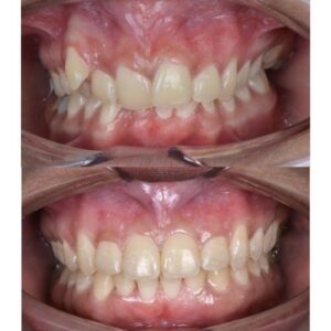 braces 3