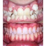 braces 4