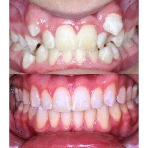 braces 4