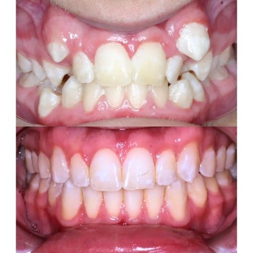 braces 4