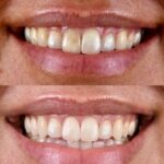 Astute Clinic | whitening before and after